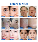 2 in 1 Rfems +Plasma Multifunctional Wrinkle Scars Removal Skin Resurfacing Face Lifting Ems Rf Machine A59