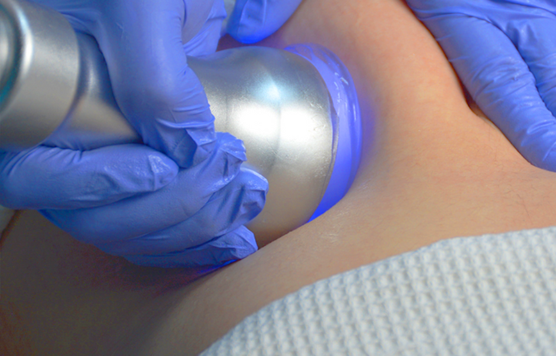 Is Cryoskin Permanent? Exploring the Longevity of Cryoskin Treatments