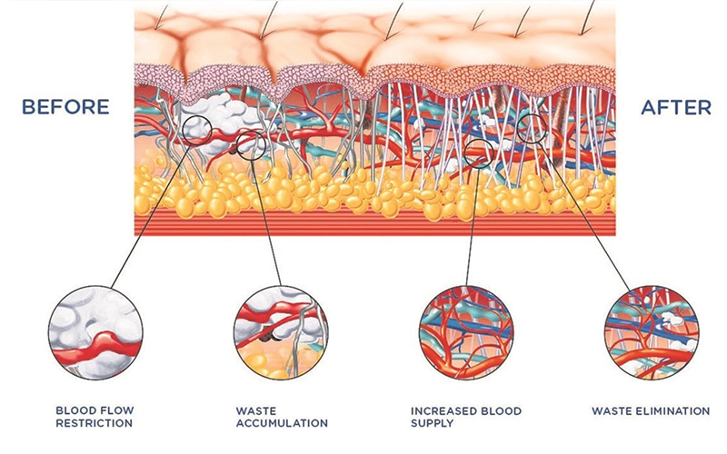 How shockwave therapy works