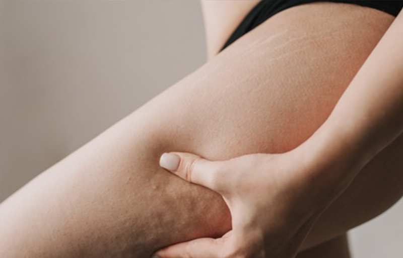 Say Goodbye to Cellulite with Shock Waves