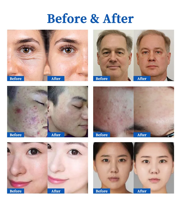 2 in 1 Rfems +Plasma Multifunctional Wrinkle Scars Removal Skin Resurfacing Face Lifting Ems Rf Machine A59