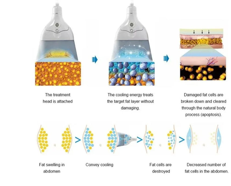 360 angle surrounding cryolipolysis cryoskin body slimming cooling skin tightening machine AGE-PRO