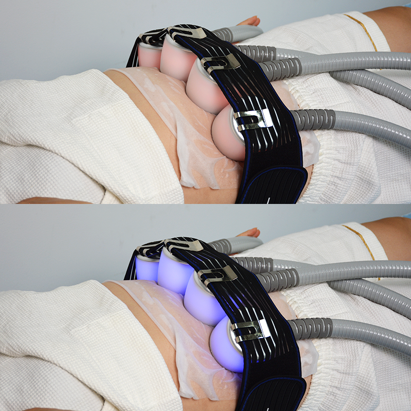 5 Handles Hot Cold Thermal Cryolipolysis Cryotherapy Cryoskin Cryo Slimming T Skin Shock Machine C11