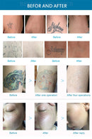 Pico Laser Tattoo Removal Machine for Skin Resurfacing and Pigmentation Removal Tattoo Machine