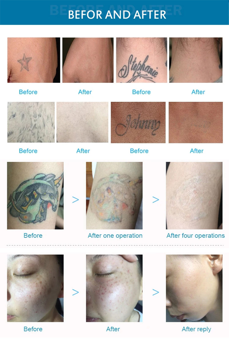 Pico Laser Tattoo Removal Machine for Skin Resurfacing and Pigmentation Removal Tattoo Machine