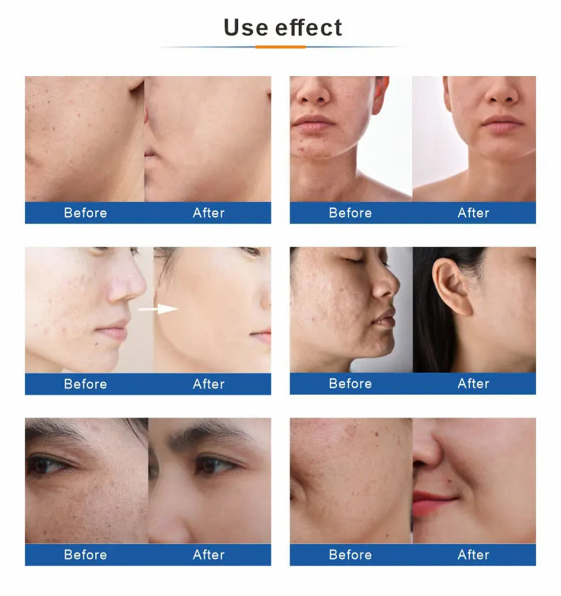 Oxygen Facial Machine Water Aqua Jet Peel Micro Dermabrasion Diamond Oxygen Facial Therapy Oxygen Jet Peel Machine