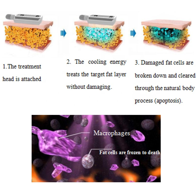 Ice sculpture board cryoskin cyrotherapy cyro therapy freeze remove fat machine cryotherapy device