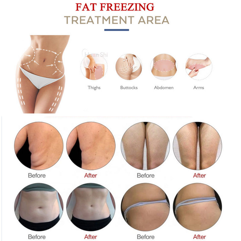 Fat Freezing Machine Cryotherapy Lipo Laser Cavitation RF Cryolipolysis Machine