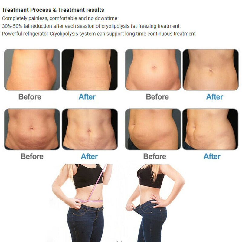 CryoLipolysis Fat Freezing 40K Cavitation RF Body Sculpting Cryo Weight Loss