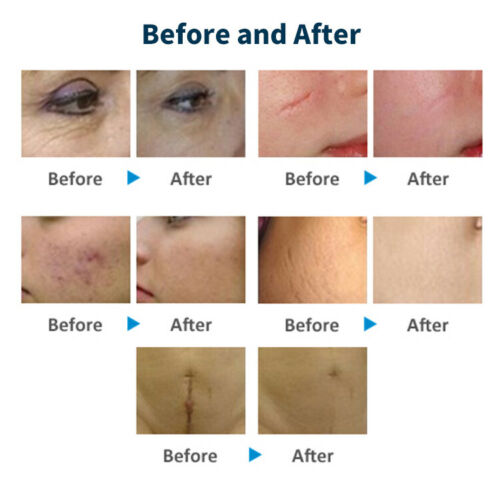 Co2 Fractional Laser Machine Skin Tightening Resurfacing Smooth Scars Acne