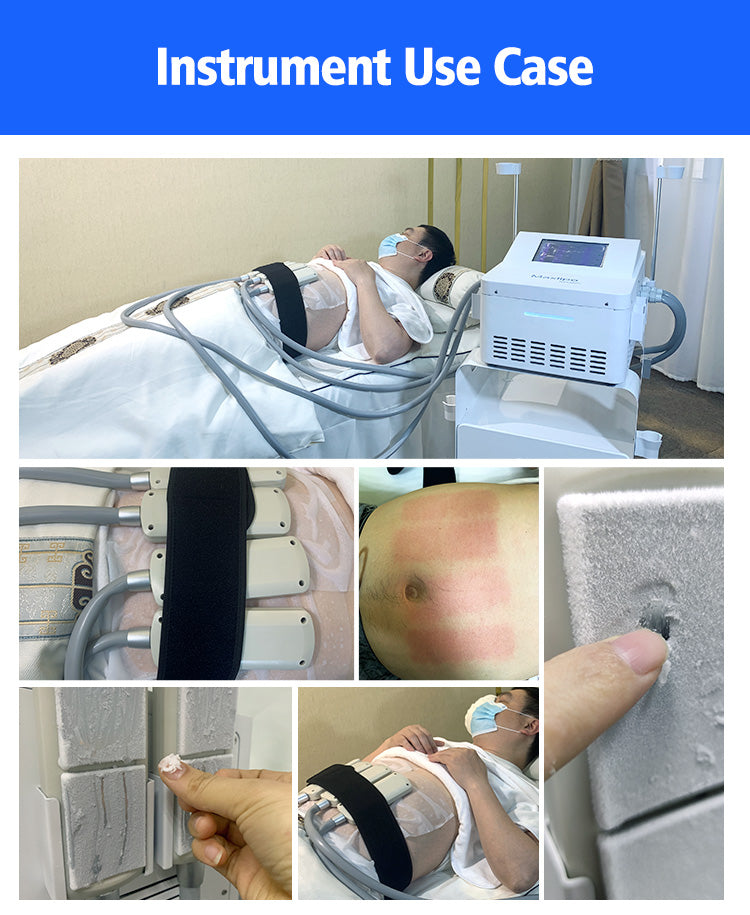 Cryolipolysis fat cellulite cryoskin skin cryotherapy ems Cryoslimming Cooling freeze Pads Lipolysis cryotherapy freeze machine