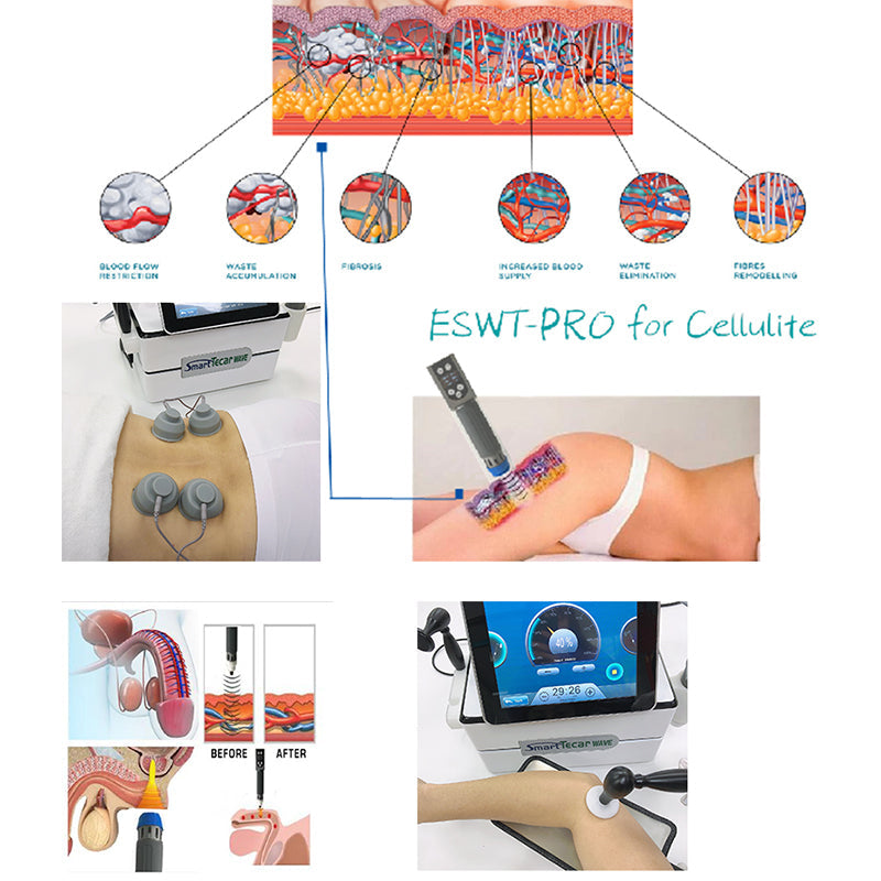 Eswt Physical Therapy Equipment Smart Tecar ems Shock Wave shockwave for Pain Relief