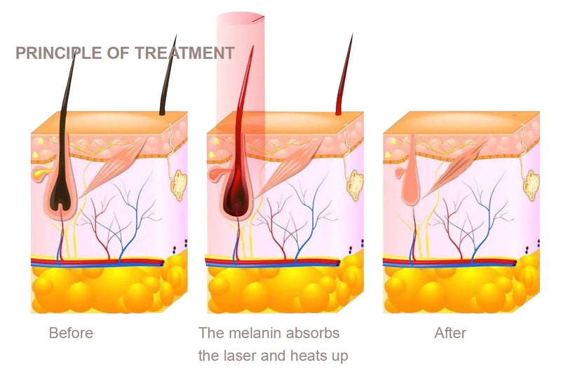 Intelligent Diode Hair Removal Laser Machine with Dual Handles